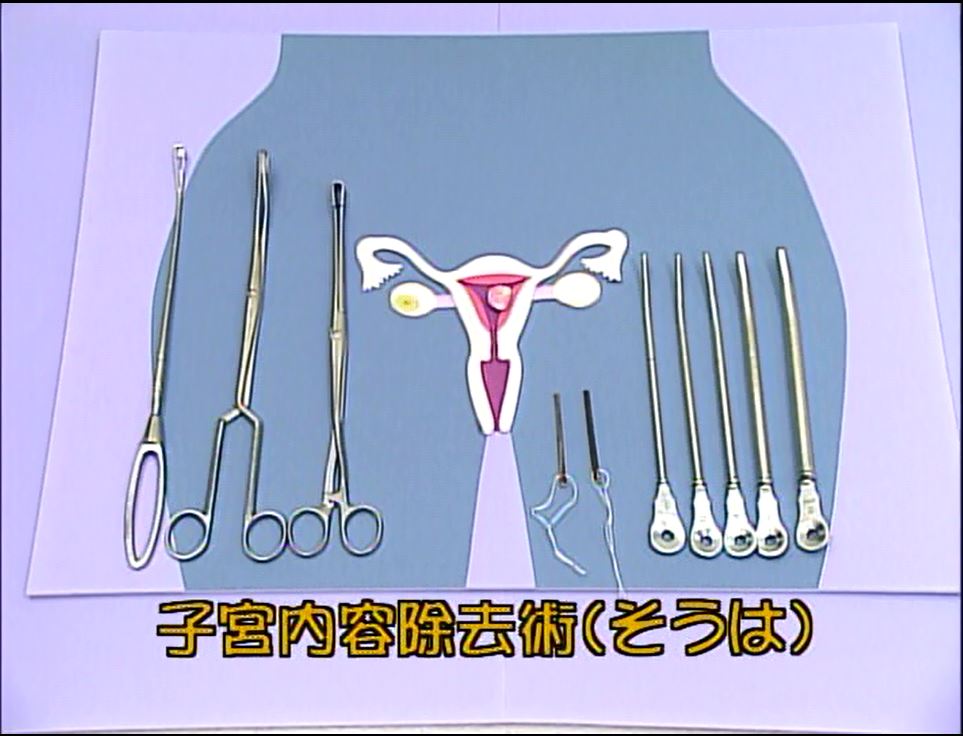 人工妊娠中絶 避妊―生徒の質問にこたえる!―